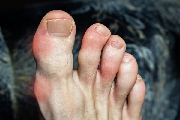 osteophytes on the toes of a foot injured by gout or Ollier disease. Inflammation and deformity of the toes. Maffucci syndrome of the toes with tumors of bone and soft tissue