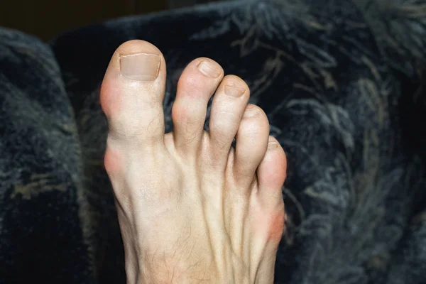 有骨赘的肿胀和畸形的手指 痛风或关节炎引起的脚趾炎症 脚趾肿胀的关节 — 图库照片