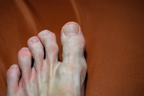 脚趾发炎和畸形 骨性和软组织肿瘤脚趾的Maffucci综合征 — 图库照片