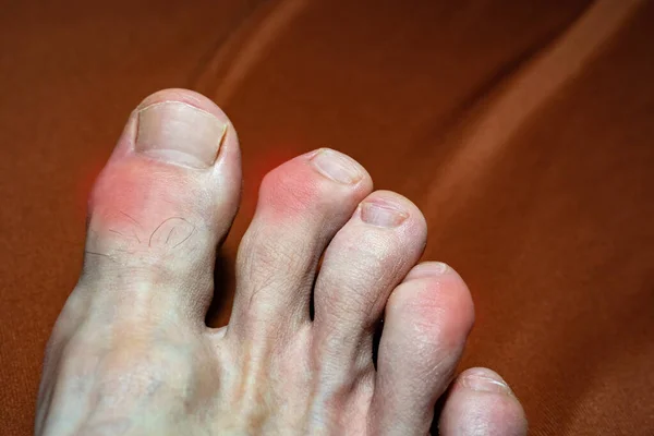 多个骨折后畸形脚趾的特写 脚趾关节的肿胀 脚趾关节痛痛性痛风 有选择的焦点 多嘴的脚趾 受痛风影响的脚趾 — 图库照片
