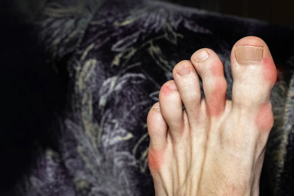 类风湿关节炎或痛风影响年轻高加索人的脚趾 急性炎症性关节炎 红肿的 肿胀的关节 痛痛性痛风炎症 选择性焦点 — 图库照片