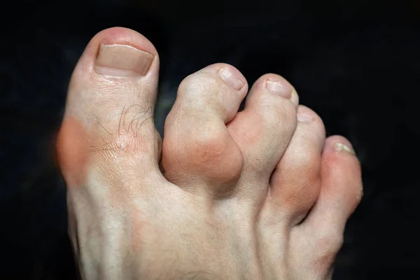 Osteophytes Toes Heberden Nodes Bouchard Nodes Inflammation Deformity Toes Toes — Stock Photo, Image