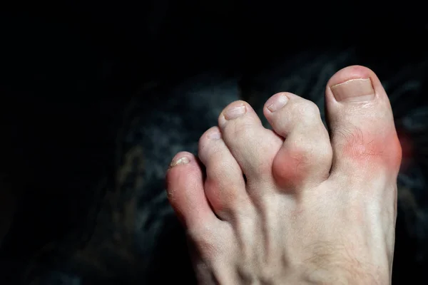 痛风或Ollier病造成的脚趾头骨赘 脚趾发炎和畸形 有骨骼和软组织肿瘤的脚趾Maffucci综合征 指骨上的骨赘 — 图库照片