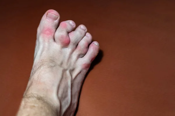 Close Gouty Toes Toes Affected Gout Disease Which Defective Metabolism — Stock Photo, Image