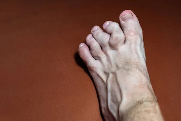 Nahaufnahme Von Gouty Zehen Zehen Die Von Gicht Betroffen Sind — Stockfoto
