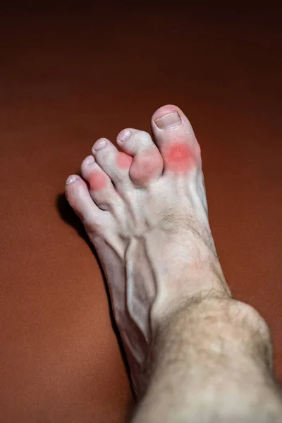 Leg Gouty Toes Toes Affected Gout Disease Which Defective Metabolism — Stock Photo, Image