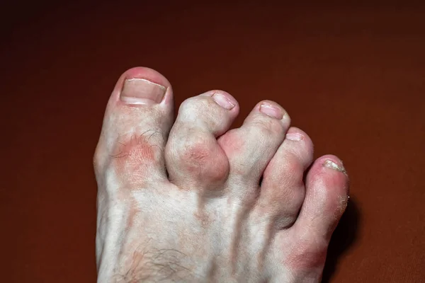 多嘴的脚趾 受痛风影响的脚趾 尿酸代谢紊乱的一种疾病 类风湿关节炎步行 有红肿斑的趾瓣畸形 有选择的焦点 — 图库照片
