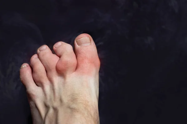 脚趾发炎和畸形 多嘴的脚趾 痛风病 一种尿酸代谢紊乱导致关节炎的疾病 — 图库照片
