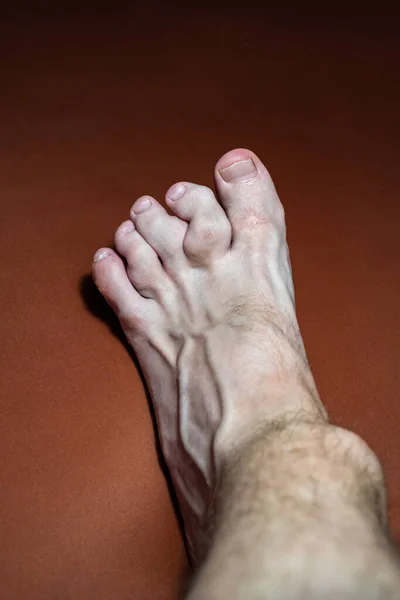 一条脚趾粗糙的腿 痛风病是一种尿酸代谢紊乱导致关节炎的疾病 尤其是在较小的骨骼中 痛风也被称为 国王之病 — 图库照片