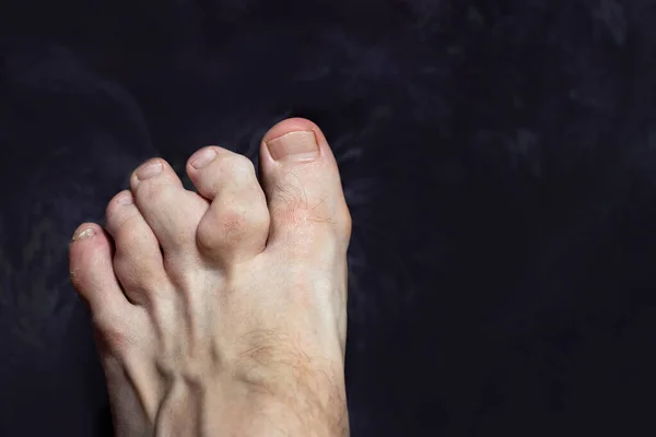 Entzündung Und Deformität Der Zehen Gouty Zehen Zehen Von Gicht — Stockfoto
