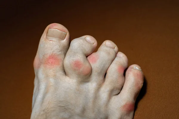 Romatoid Artrit Gut Genç Beyaz Adamın Ayak Parmaklarını Etkiler Akut Stok Fotoğraf