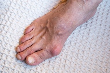 inflamed bones on the toes of a Caucasian woman. inflamed and deformed joints on the toes due to arthritis or gout clipart
