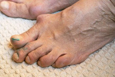 Orta yaşlı bir kadının ayak parmaklarında iltihaplanmış ve deforme olmuş eklemler var. Eklem iltihabı, gut, yakın plan, seçici odaklanma.