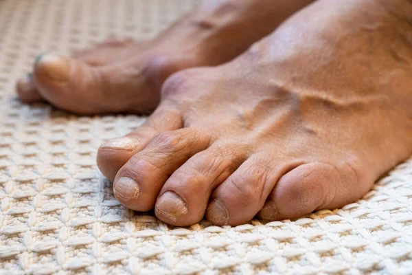 warped, cracked, and scratched nails on the feet of an elderly woman. deficiency of vitamins and minerals, which leads to problems with nails and skin