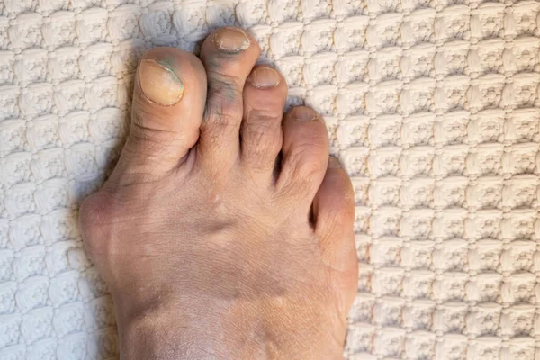 Inflamed Deformed Joints Leg Gouty Toes Toes Affected Gout — Stock Photo, Image