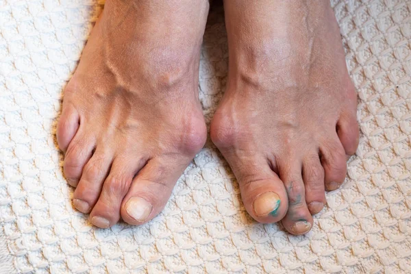 脚趾关节痛痛性痛风 脚趾发炎和畸形 — 图库照片