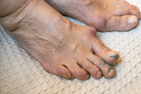 Osteophyten Den Zehen Eines Fußes Der Durch Gicht Oder Ollier — Stockfoto