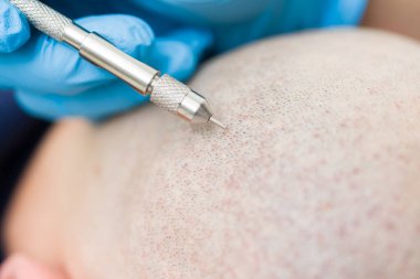 Tıbbi uzman, bir hastaya saç nakli prosedürü uyguluyor, folikülleri restore ediyor ve androjenik alopeciyi tedavi ediyor.