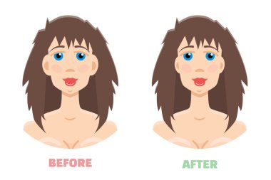 Botox enjeksiyonları illüstrasyon 