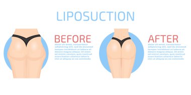 Renkli Liposuction infographics
