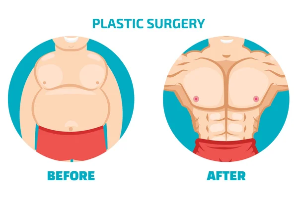 Chirurgie plastique homme — Image vectorielle