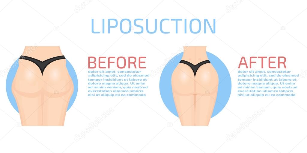 Colorful Liposuction infographics