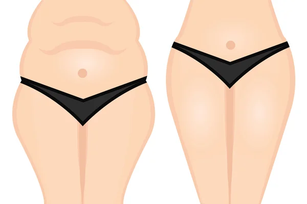 Şişko göbek Liposuction — Stok Vektör