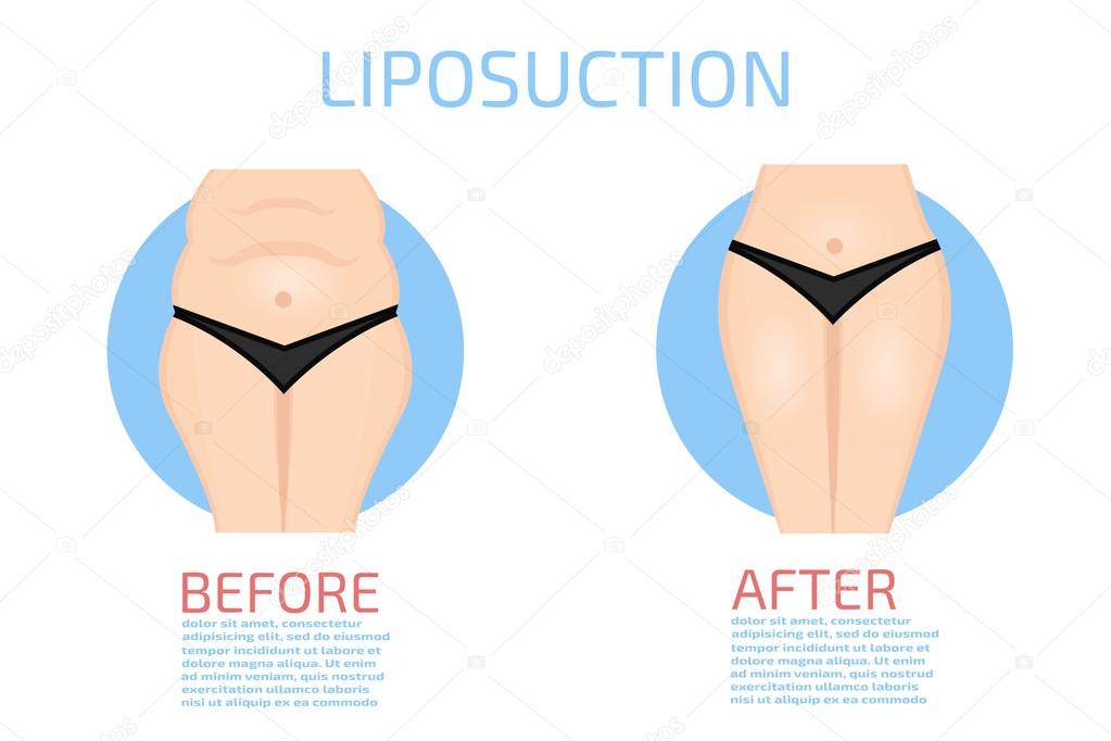 Colorful Liposuction infographics