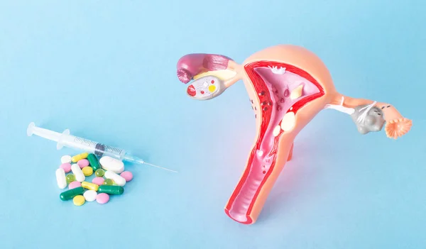 Mock up of the female reproductive system and a bunch of pills and injections on a blue background. Concept of drug treatment of genital infections, antibiotics, trichomoniasis — Stock Image Mock up of the female reproductive system and a bunch of pills and injections on a blue background. Concept of drug treatment of genital infections, antibiotics, trichomoniasis Stock Image