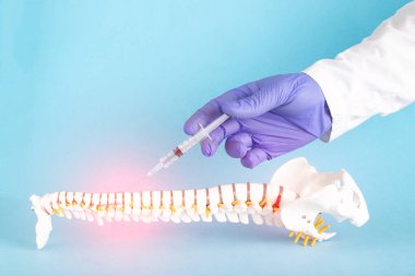 Mavi arka plandaki insan omurgasının bir modeli. Doktorun omurga fıtığına enjeksiyon yapmak için kullandığı şırınga. Radiküler sendrom ve sırt ağrısı için tedavi kavramı, metin için kopyalama alanı, prosedür