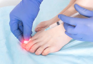 The doctor makes an injection in the joint of the toe for arthrosis, swelling and inflammation in the joint. Concept of joint regenerating injections with ozone-oxygen mixture, ozone therapy