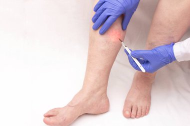 A phlebologist holds a scalpel near the patient's leg of a woman who has varicose veins in her legs. Concept of modern vein removal with phlebectomy, treatment