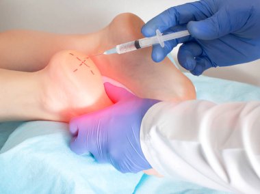 The doctor makes injections into the heel of the foot on the patients leg with a heel spur. Concept of treatment and pain relief for osteophyte growth, plantar fasciitis