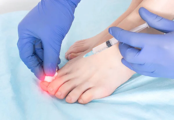 Doctor Makes Injection Joint Toe Arthrosis Swelling Inflammation Joint Concept — 스톡 사진