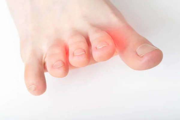 Crooked Stiff Toe White Background Interdigital Neuralgia Macro Copy Space — Stock Photo, Image