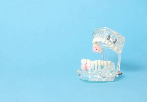 Modelo Mandíbula Dental Sobre Fondo Azul Concepto Enfermedad Dental Inflamación — Foto de Stock