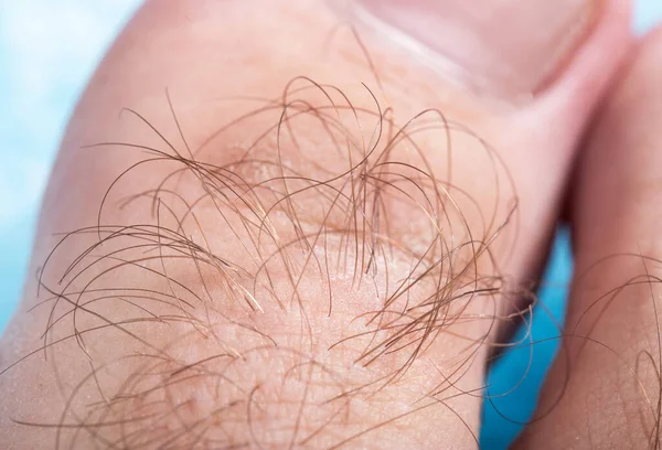 Włosy Palcu Mężczyzny Makro Higiena Koncepcji Depilacji — Zdjęcie stockowe