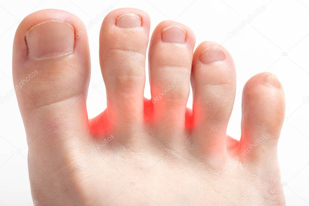 Redness between the toes, onychomycosis, macro. Foot fungus disease treatment concept
