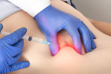 Doktor bir kıza anestezi iğnesi yapar. Cerrahi bir ameliyattan sonra karnına bir ambargo. Doğumdan sonra karnındaki anestezi kavramı, epidural anestezi.
