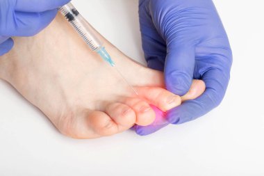 Doktor ayak parmakları arasında hiperhidroz terlemesine karşı bir enjeksiyon yapıyor. Hoş olmayan ayak kokusu tedavisi konsepti