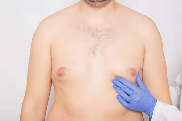  Gynecomastia Patient