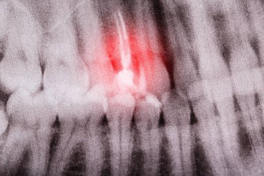 Diş röntgeninde diş pulpitisi, makro. Kök kanallarında ve sinirlerde iltihap var. Kronik periodontit.