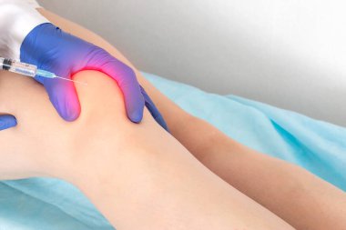 Doktor hastanın diz eklemlerine eklem içi uyuşturucu enjekte edilerek delik açıyor. Ağrıyan dizine ilaç enjekte etmek, terapi.
