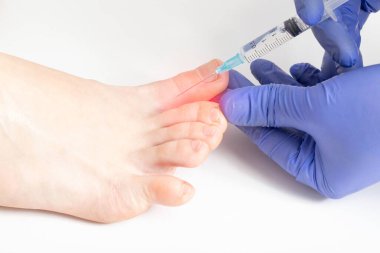 Doktor ayak parmakları arasında hiperhidroz terlemesine karşı bir enjeksiyon yapıyor. Hoş olmayan ayak kokusu tedavisi konsepti