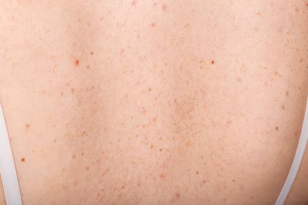 Manchas Pigmentadas Espinhas Pele Das Costas Menina Dermatologia Conceito Alergia — Fotografia de Stock