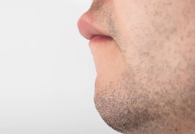 Bir adamın geniş bir üst dudağı vardır, yakın plan. Plastik cerrahi, cheiloplasti, artırma kullanarak dudak küçültme ve düzeltme