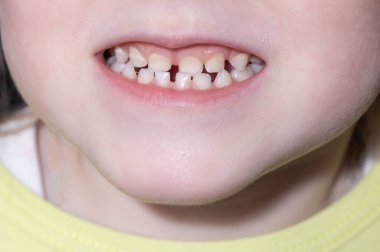 Ağzı açık ve süt dişli küçük bir kız. Çocuklarda ağız boşluğu ve bebek dişi için uygun bakım konsepti, yakın plan. Dişçi