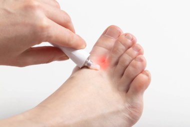 Kız ayak parmaklarının arasına derinin soyulması ve tahrişe karşı şifalı bir merhem sürüyor. Hoş olmayan bir koku, dermatolojik bir koku.