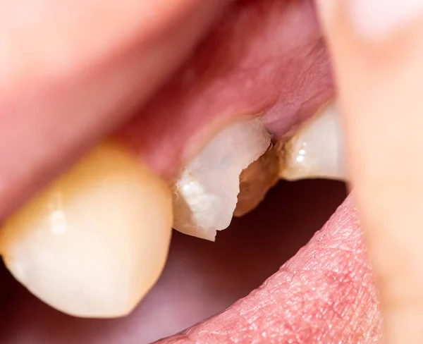 死んだパルプの歯のチップ片 歯の損傷した歯の回復 歯のエナメル質の欠陥 薄い歯の壁 マクロ治療 — ストック写真