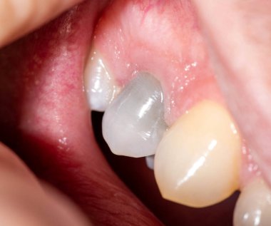 Sinir alınması ve pulpitis hastalığından sonra koyulaşan gri dişler. Modern dişçilik ve sağlık sektöründe diş gıdası eksikliği, yenileme ve ölü bir dişin restorasyonu